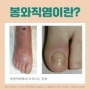 질병 "봉와직염 Cellulitis" 이미지