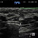 breast mass (elastography) 이미지