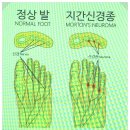 지간신경종 발바닥통증은 발가락운동용구 듀트 착용하고 해결하세요 이미지