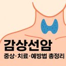 갑상선암 바로 알기 이미지