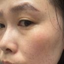 1회 사진기록전 | 인천구월동피부과 기미제거 1회차 전후 후기 효과 내돈내산