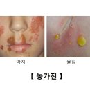 농가진(Impetigo) 피부질환이란? 이미지