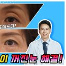 눈꺼짐에 관한 지방재배치 해보신 분있나요? (관련 유투브링크 포함) 이미지