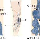 하지정맥류! 하지정맥류의 원인과 치료, 예방에 대한 모든 것을 알아봅니다 / 삼성서울병원 심장혈관센터 / 하지정맥류 이미지