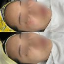 태나 TAENA | 인천 주안 도화동 피부관리 '태나뷰티' 내돈내산 기미 잡티 제거 3회 후기