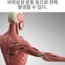 무리한 운동으로 근육이 녹는 횡문근융해증이란? 증상 원인 치료 알아두기 이미지