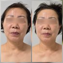 본리초등학교 | 죽전역 감산동 청아피부체형관리실, 60대 엄마 어깨 통증과 어지럼증 관리 후기