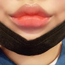 마인드닥터의원 | 아름닥터 병원 / 강남라렌의원 / 팔자필러 + 입술필러 5일차 후기