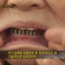 임플란트 안해도 되는데 사기쳐서 심게하는 프랜차이즈 치과들!! 여기서 임플란트 하면 안됨!! 이미지