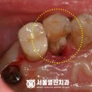 타병원에서 실패한 임플란트 , 지축 치과 서울열린 에서 말끔히 해결!