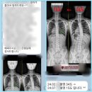 랑필라테스 - 강남구 논현로102길 11 | 상일동 필라테스, 고덕동 필라테스 랑필라테스 척추측만증 교정 사례 34도 > 9도 교정 운동!