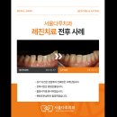 함박웃음치과의원 | 벌어짐 레진 가격과 당일치료 후기,라미네이트,앞니교정없이, 잠실 치과 단골 환자분도 놀란 전후 차이