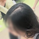 연세모벨르의원 | 인천 탈모 병원 | 아르케 주사 치료 효과 진짜 있을까요?