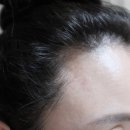 디에이치메디 | 예쁜 헤어라인커버는 디에이치메디케어로 깔끔하게 정리!