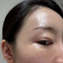 딱지 | 편평사마귀 제거 일주일 후기 (딱지, 회복기간, 솔직후기)