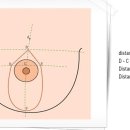 유방비대증 이미지