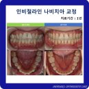 동호아름다운치과의원 | [분당교정치과] 나비치아 인비절라인 후기: 삐뚤빼뚤한 앞니의 변신
