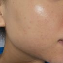 파크뷰의원 | 여드름 색소침착 레이저치료 후기, 가성비 좋은 피부과 시술