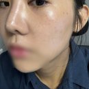 의정부 기미잡티패키지 피코토닝받고 깨끗해진 내돈내산후기