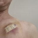 ICD 시술 2주 되었네요.. 이미지