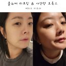 강남종합의료기 | 볼뉴머 가격 효과 솔직 정리｜리프팅 시술 전 꼭 알아야 할 핵심 후기