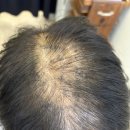 광산구-157 | 광주 정수리 두피문신 후기｜정수리 휑함 자연스럽게 커버한 실제 사례