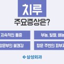 치루개 이미지