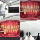 이화치과 - 광양시 칠성로 51 | 당산 치아미백 치과 솔직후기│원데이 치아미백 시술 통증 가격 변화 리뷰