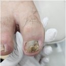 로다샵 | 목포발톱무좀 두꺼운발톱 제대로 관리받았어요 페디크루 로다풋케어