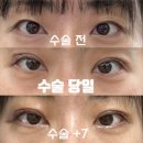 멍이방앗간 | 7년 묵은 나의 고민, 쌍꺼풀 - 자연유착 일주일 후기