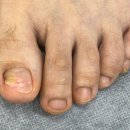 네일디바&레푸스 건대점 | 건대 구의동 발톱무좀 복원까지 말끔히 네일디바&amp;레푸스건대점