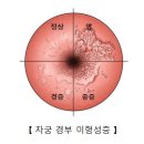 자궁 경부의 이형성증 이미지