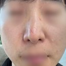 인천더드림병원 | [솔직후기+내돈내산] 비염 및 비밸브 기능 수술 + 코성형 (삼성드림 이비인후과 인천송도점)