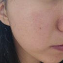 연세수약국 | [내돈내산] 연세보드미의원 편평사마귀 제거, 예약 및 시술 후기