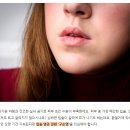 겨울철 트고 갈라지는 입술, '구순염' 이미지