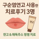 H-010 | 구순염연고 사용한 치료후기3명