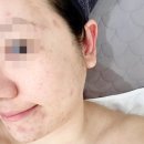 진뷰티 | 위례 에스테틱 올가드림뷰티 위례점 피부 맑아진 후기