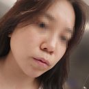 별과달 | [안양성형외과] 경기도권에서 제일 큰 성형외과 가서 코 조각주사 받고 온 후기!(이브코 시술)