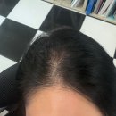 리안헤어 | 용인 죽전 원형탈모 치료 후기 리안헤어 용인 보정점