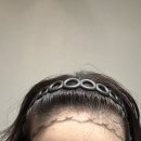 모제림외과의원 | [웨딩준비] 모제림성형외과 헤어라인 교정 모발이식 상담후기