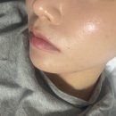 서울에스티셀의원 | 유에이치셀 서초 UHCELL 서초 온다·올리디아120·그랜모어 3일 경과 솔직후기
