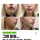 포인트성형외과의원 네이버블로그