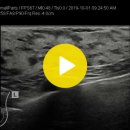 breast-Fibroadenoma 이미지