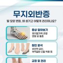 송파원정형외과의원 네이버블로그