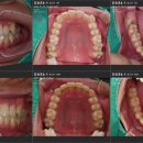 대광치과의원 | 치아교정 세라핀 교정 후기/투명교정기