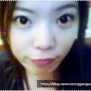 렌즈아이메디칼(주) | [공지] 렌즈삽입술 20년 실제 후기, 2006년 수술 통증·실밥 제거·현재 시력까지