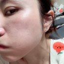 케어약국 | 약국여드름크림 추천 닥터딥 스팟크림 후기 피부 요철케어