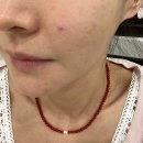 새살침 4회차 내돈내산 후기, 모공흉터 때문에 결국 한의원을 옮겼어요