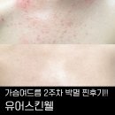 솔솔약국 | 검단피부관리 가슴여드름 유어스킨웰 약초필 2주일 변화 대만족 찐후기