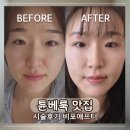 볼륨 | 한티역 피부과 튠페이스 쥬베룩볼륨 후기
